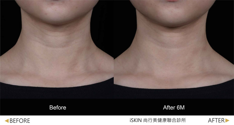 以Volite劑型治療,脖紋線條明顯淡化,肌膚質感細緻度提升 (實際效果因人而異)