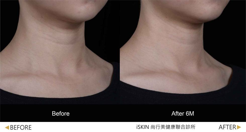 以Volite劑型治療,脖紋線條明顯淡化,肌膚質感細緻度提升 (實際效果因人而異)