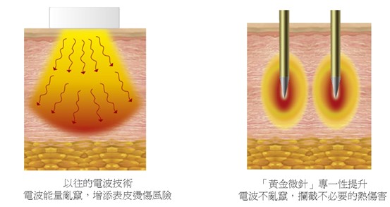 （左）以往的電波技術能量容易亂竄，增加表皮燙傷風險；（右）標靶探頭的黃金絕緣針深入皮下，同時在針尖釋放電波，可以準確到達治療區域，攔截表皮的熱傷害。