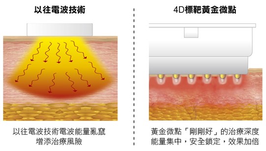 （左）以往的電波技術能量容易亂竄，增加表皮燙傷風險；（右）基底探頭的黃金微點鎖定「剛剛好」的治療深度，更加舒適和安全。