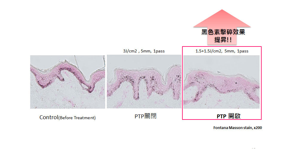 新一代淨膚雷射-日式美姬PTP強力淨化系統提高黑色素擊碎效果。