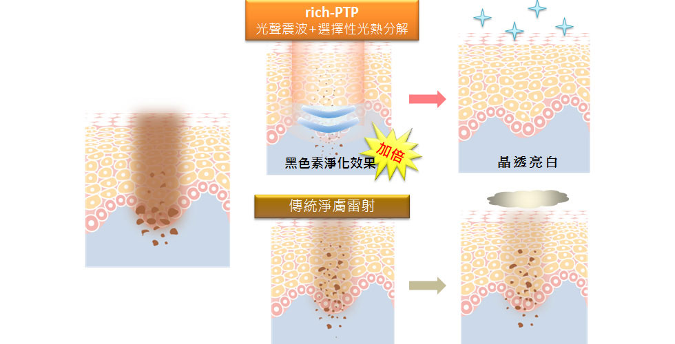 新一代淨膚雷射-日式美姬與傳統淨膚雷射的黑色素淨化效果比較，因為增加了PTP模式，可以增加治療寬度以及減少熱傷害，所以淡化色素的效果更好、更安全。