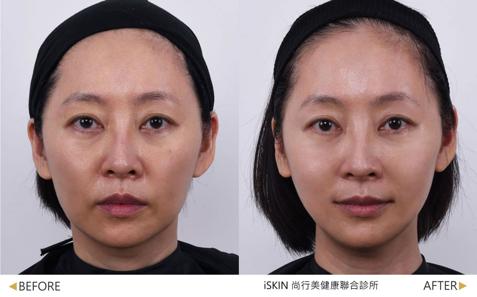 薇貝拉治療一次一個月後效果，以針劑方式治療，使用薇貝拉大分子改善頰凹老態感。(複合式療程案例:薇貝拉+EMFACE+無限電波，實際效果因人而異)