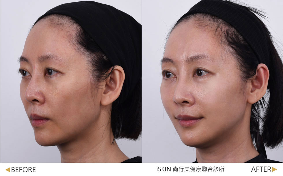 薇貝拉治療一次一個月後效果，以針劑方式治療，使用薇貝拉大分子改善頰凹老態感。(複合式療程案例:薇貝拉+EMFACE+無限電波，實際效果因人而異)