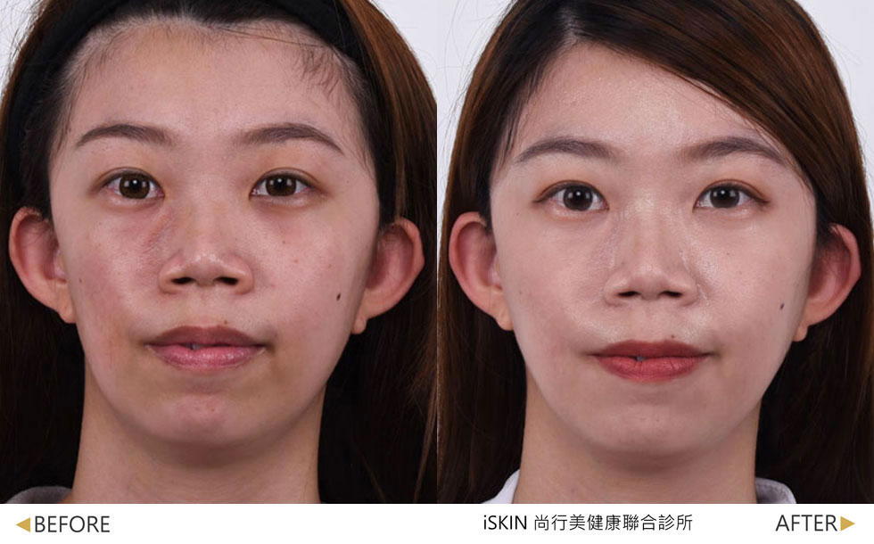  薇貝拉治療一次一個月後效果，以針劑方式治療，薇貝拉大分子改善臉型不對稱。(實際效果因人而異)