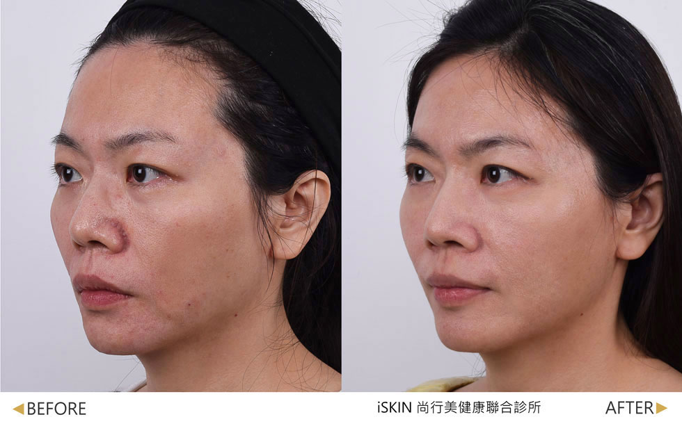 薇貝拉治療一次一個月後效果，以針劑方式注射薇貝拉大分子改善頰凹老態感，再使用薇貝拉小分子，以水光針治療些許凹疤問題。(實際效果因人而異)