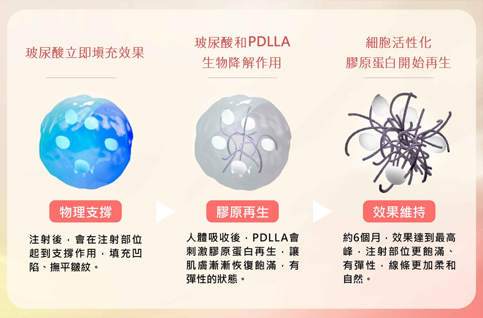 薇貝拉魔法針結合玻尿酸與PDLLA聚雙旋乳酸，刺激膠原蛋白新生，使肌膚漸漸飽滿有彈性，填補凹陷、撫平皺紋，約六個月效果達到高峰。