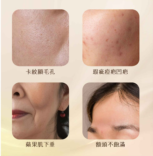 薇貝拉魔法針可改善卡紋顯毛孔、瑕疵痘疤凹疤、蘋果肌下垂、額頭不飽滿。
