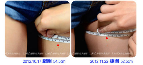 左圖治療前腿部54.5cm，一個月後已經變成52.5cm！