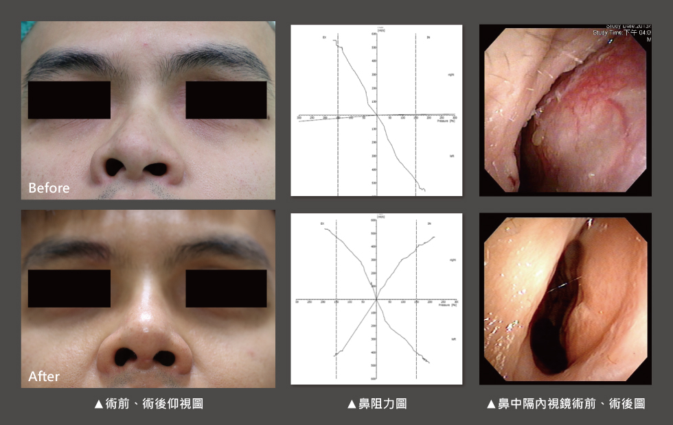 透過手術前後鼻阻力圖對照，術前右側鼻阻力線都接近水平線，表示呼吸阻力極大，術後鼻阻力線恢復正常曲線，接近兩邊對稱，表示呼吸恢復暢通，傷口也恢復良好。