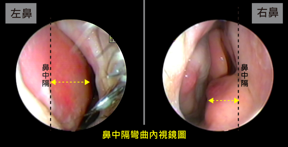 這是我的鼻中隔彎曲內視鏡圖