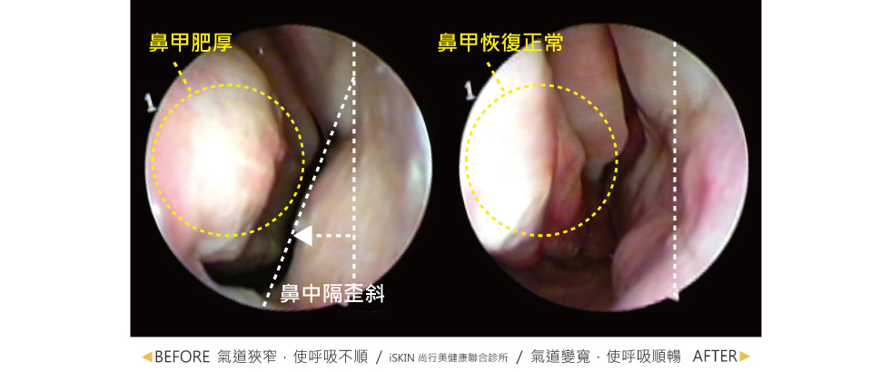 術前因為鼻甲肥厚跟鼻中隔歪斜，使氣道狹窄，導致呼吸不順暢。針對鼻甲肥厚的問題施作廣達雷射來縮小鼻甲體積，並施作鼻中隔彎曲手術，術後氣道變寬氣流呼吸順暢。