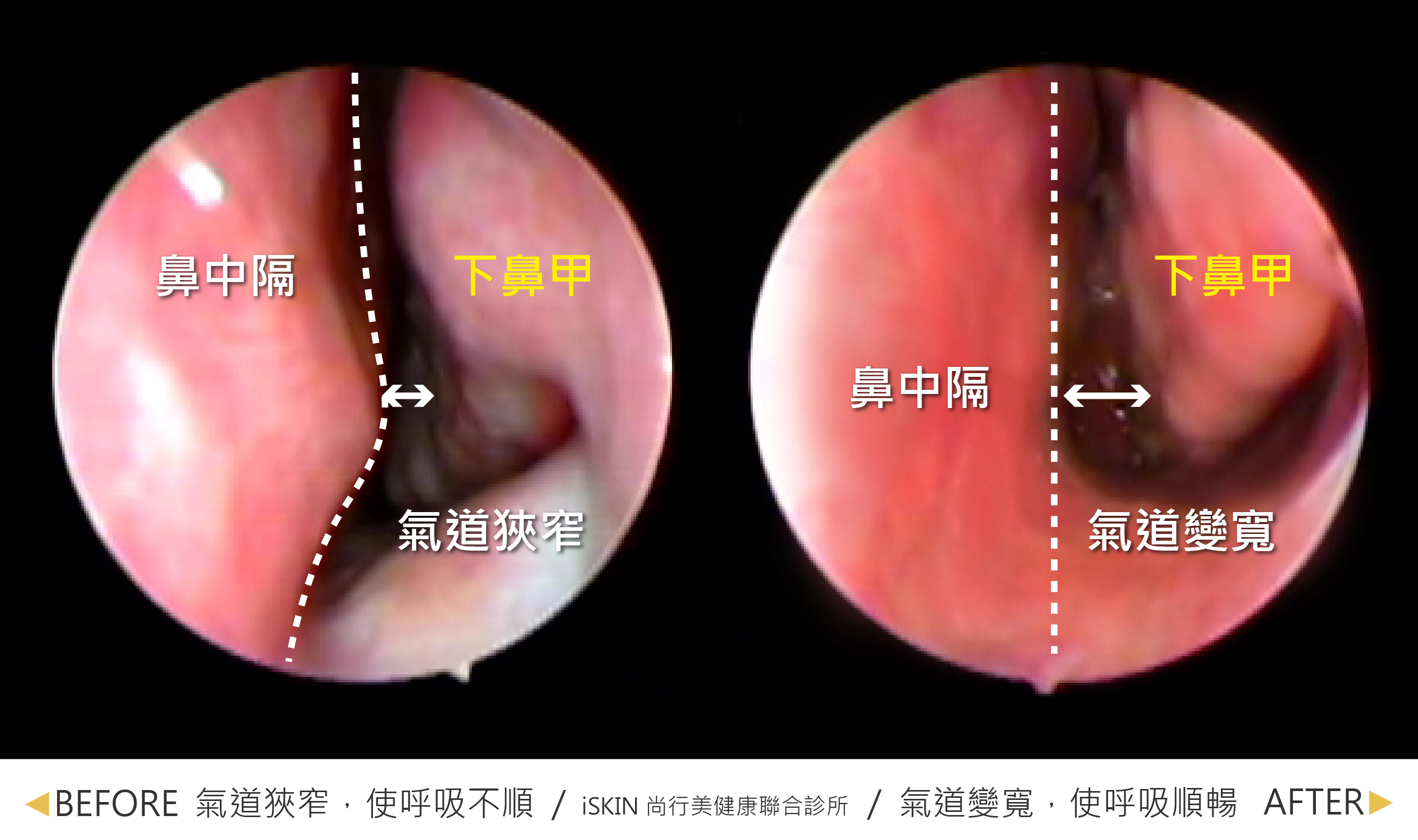 在廣達光纖雷射＋鼻中隔彎曲治療後，下鼻甲體積縮小以及鼻中膈變直做改善，氣道變寬，呼吸也更順暢。