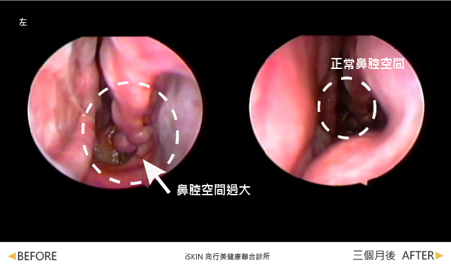 標示處為下鼻甲，在經過兩次傳統手術切除後，下鼻甲所剩無幾（如箭頭標示處），導致Henson鼻腔空間過大。