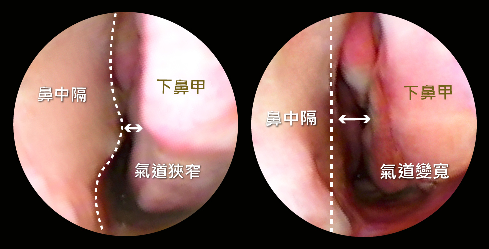 手術前左圖： 透過鼻腔內視鏡檢查，可以看出鼻中隔彎曲及下鼻甲肥厚的症狀，鼻道空間很狹窄，難怪我常鼻塞QQ   手術後右圖： 經過治療後，下鼻甲體積縮小了，鼻中隔不再彎曲，鼻道空間變寬了，呼吸順暢到不行！