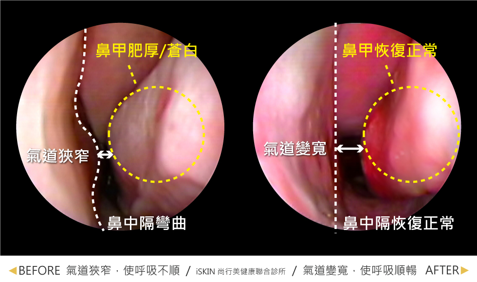 從鼻腔內視鏡可以看到，原本狹窄的氣道變寬了，蒼白肥厚的鼻甲也恢復正常大小，血液循環變好、有了血色！空氣進得來，呼吸自然就暢通無阻，不再鼻過敏流鼻水。