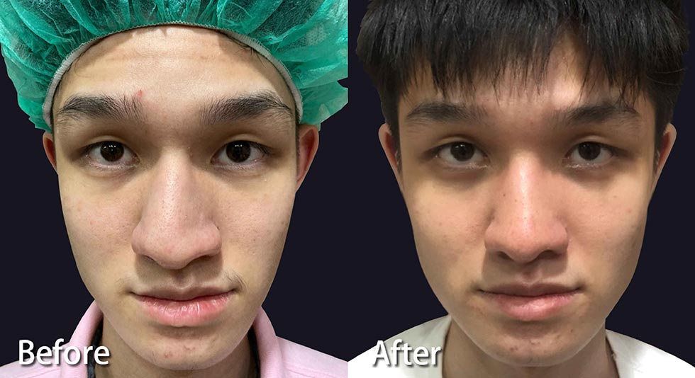 術前(左)鼻形明顯歪斜，術後(右)一個月鼻子置中不再歪斜，兩邊鼻子自然對稱，手術的腫脹、不適感也幾乎消失，恢復良好。