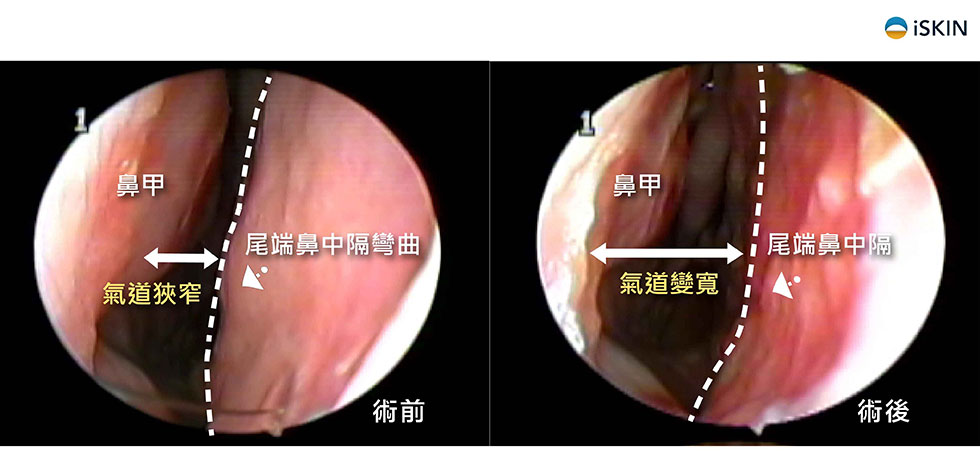 此病患為右側尾端鼻中隔彎曲，造成鼻子入口處空氣進去受阻，接受鼻中隔旋轉繞道術(Swinging door maneuver)及軟骨切痕縫合術(Scoring&Sutures)，如右圖整個最前端的鼻中隔變直，讓氣道變通暢。