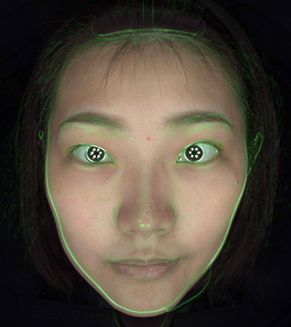 專業級肌膚檢測儀數據顯示，臉部照為術前輪廓，綠色疊影為施打一個月後之輪廓線照，由專業檢測儀測出，經玻尿酸的拉伸力改善右臉頰下垂，右臉頰已拉提，使臉型輪廓較為協調對稱。