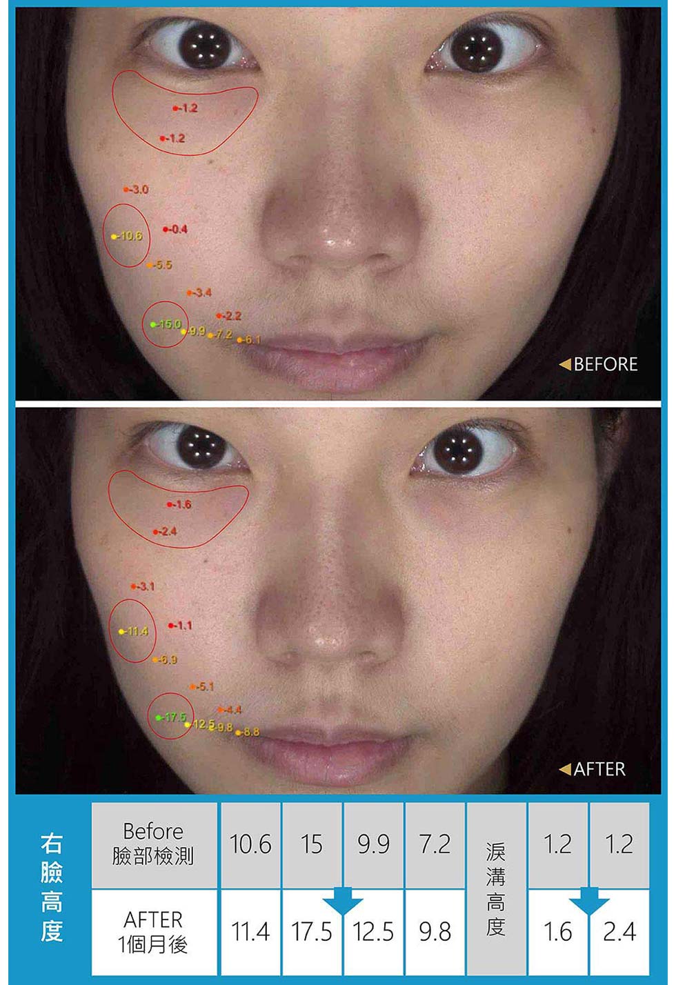 專業級肌膚檢測儀數據顯示，Before和After比較；如上數字一個月後，臉部高度的檢測數字明顯提高，表示右臉頰調整拉提。