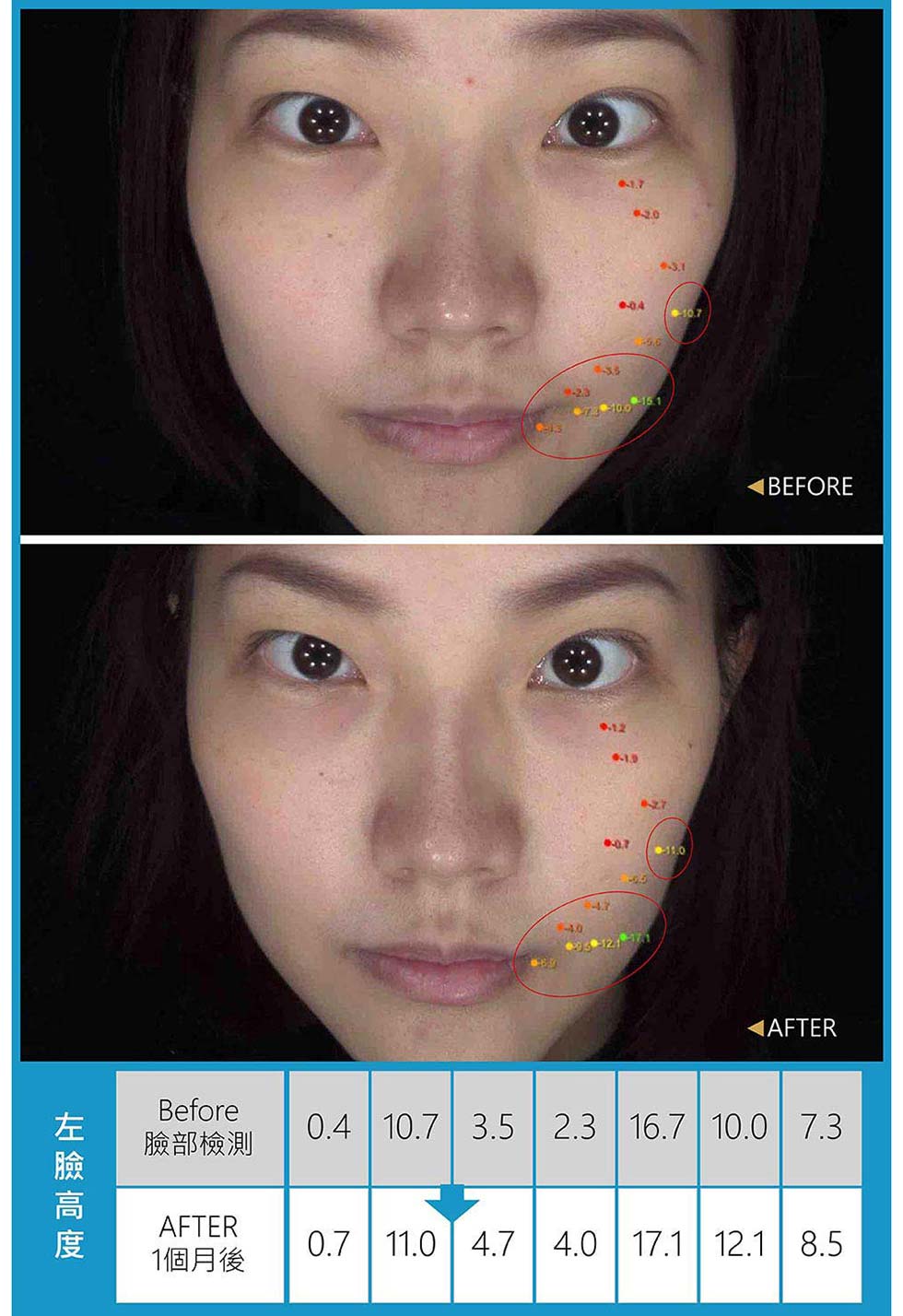 專業級肌膚檢測儀數據顯示，Before和After比較；如上數字一個月後，臉部高度的檢測數字明顯提高，左下臉頰調整平衡及澎潤提升。