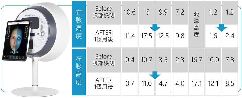 專業級肌膚檢測儀數據，Before和After比較；如上數字為臉部高度的檢測，數字高代表此部位臉頰較支撐和澎潤，數字低代表此部位臉頰較凹陷。