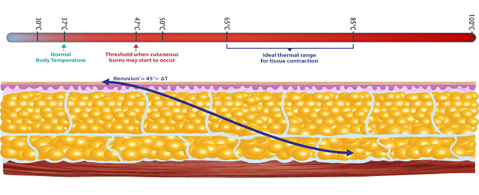 獨特氦氣電漿核新專利技術，瞬間在0.2秒加熱纖維中隔至85度C，促使皮下脂肪層的全面緊緻拉皮，使表皮與組織達到極致緊縮度。