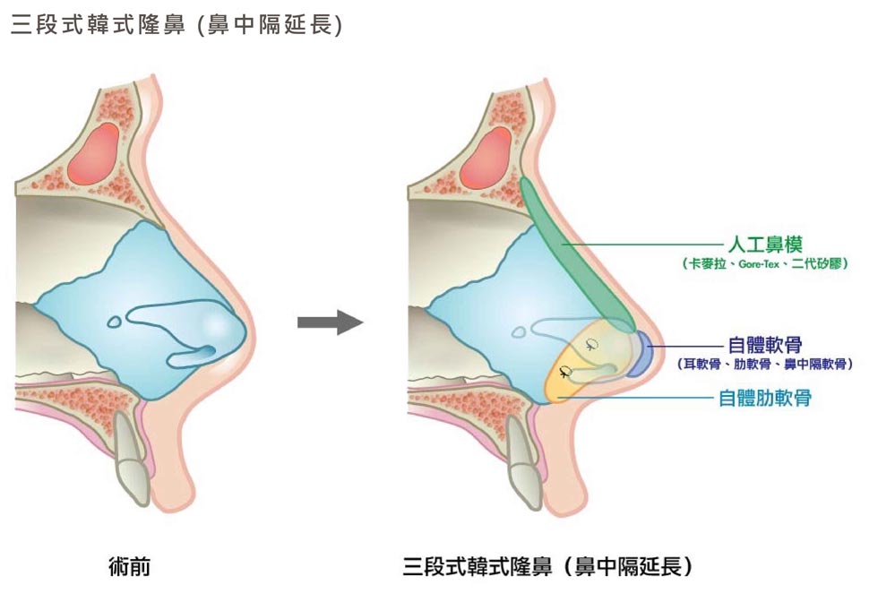 三段式隆鼻剖析圖。