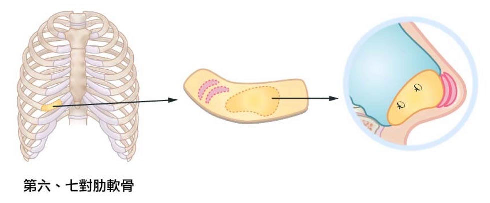 取第六、七對肋軟骨。