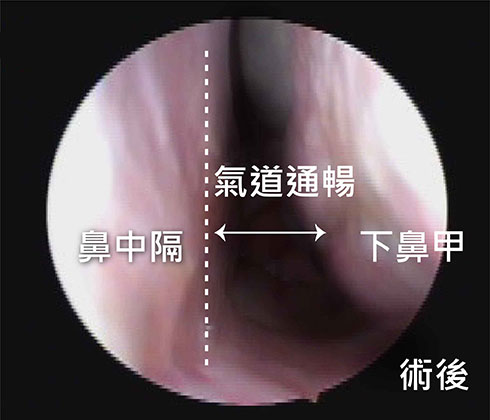 after 雷射後下鼻甲體積減小。