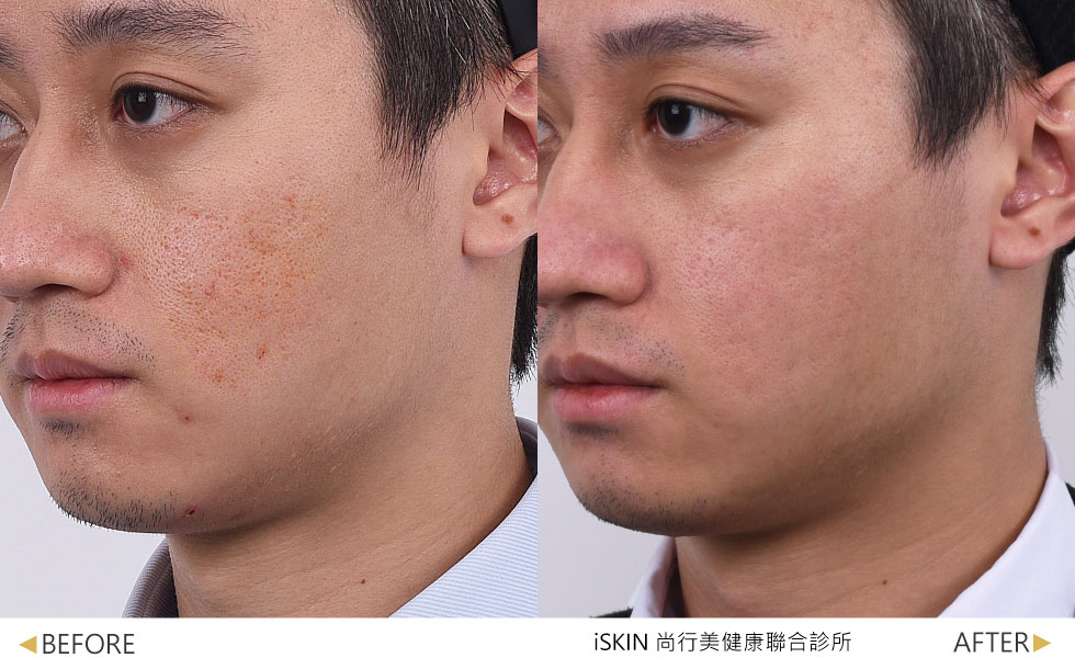 臉頰凹疤導致肌膚凹陷不平整，經過3次治療改善凹疤及刺激膠原蛋白增生，使臉頰較為平滑。
