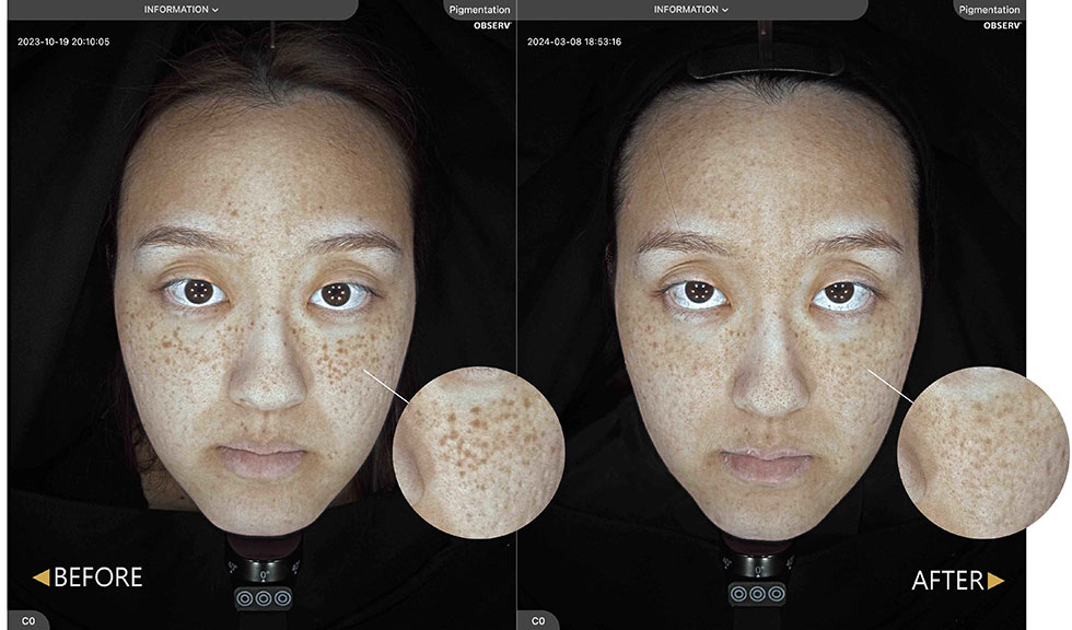肌膚檢測在斑點模式下，可看出原本臉頰上較深的深層斑點，經過兩次治療後已淡化許多。
