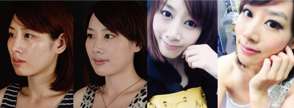 術前術後Before & After淚溝凹槽明顯改善,看起來飽滿膨彈(照片由S小姐本人所提供)。