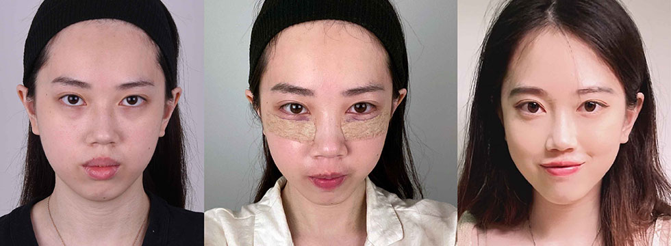 術前當天紀錄照 → 手術後3天的自拍照 → 術後3個月後上點淡妝就可以出門好方便!