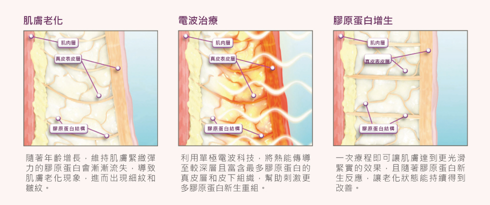 鳳凰電波的治療原理,簡單說就是透過電波刺激真皮層和皮下組織,讓膠原蛋白新生,自然讓皮膚更緊緻喔!