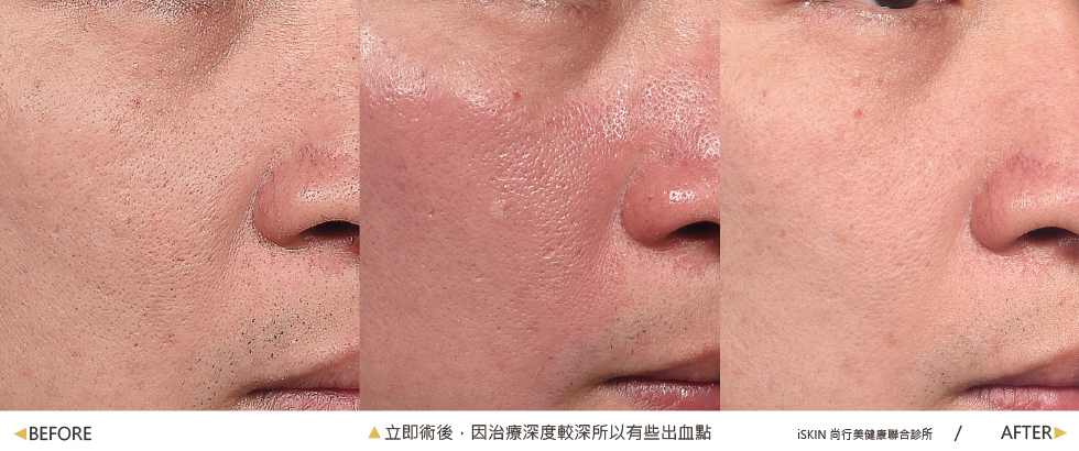 診所很細心幫我拍了照片做紀錄,治療前後毛孔與肌膚細緻度真的差很多!