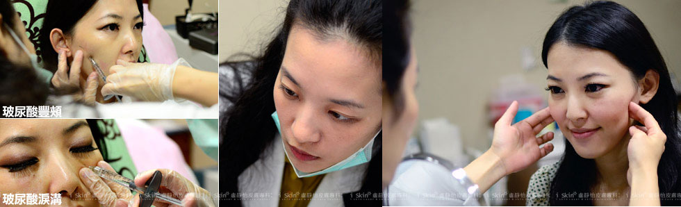 (圖蔡醫師會先消毒注射部位,畫上記號就開始玻尿酸豐頰注射與淚溝修補,注射時間約15分鐘完成,術後冰敷部位就大功告成了)