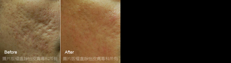 Mosaic微創飛梭治療痘疤 (以上案例皆經過當事人同意露出)