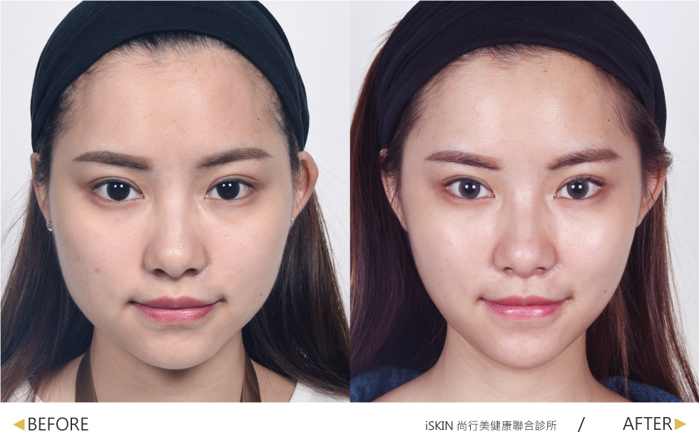 我原本的下巴也不算圓,仔細看看還是有需要調整的空間。變V了!!整個人就是小一號的概念R~~~與韓系女神零距離!