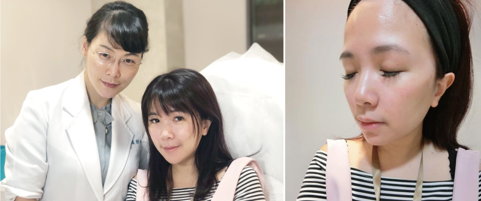 打完玻尿酸後立刻明顯覺得「臉部線條有拉提感、法令紋也變淡了」!且術後臉部腫脹不明顯(不會被發現做了醫美)(嘿嘿~)