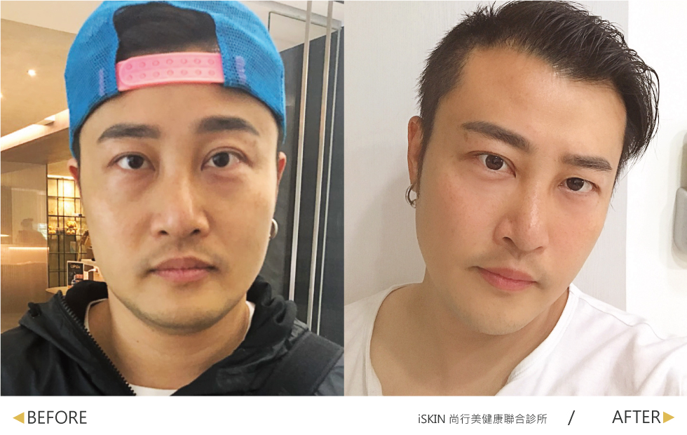 經過林君曄醫師的玻尿酸與除皺瘦臉針治療,我的淚溝獲得修復,魚尾紋也消失了,整個人看起來像年輕了幾歲!
