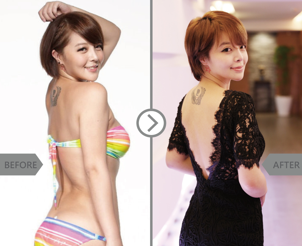 針對背後肉做了冷凍溶脂,效果超好的,背部完全是性感流線型曲線。