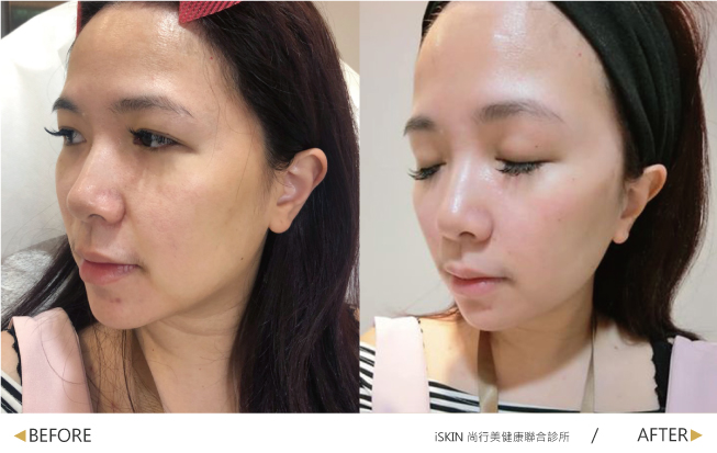 術前隨手拍了一張來跟術後比一比,法令紋真的比較不明顯了,盧醫師也有幫我打中頰拉提,整個側臉看起來比之前更緊實精緻,立即改善我的鬆鬆臉。