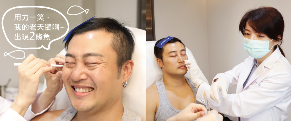 因為開朗讓我的眼尾動態紋尤其明顯,除皺瘦臉針能降低眼尾的肌肉收縮,間接消除魚尾紋。
