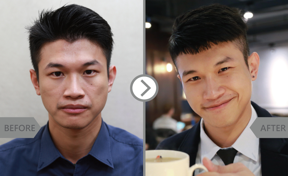 自己因為愛笑而產生很多細紋,透過玻尿酸填充後我覺得眼部魚尾紋跟臉部上細紋真地變少了,下巴與臉型也瞬間變對稱了。