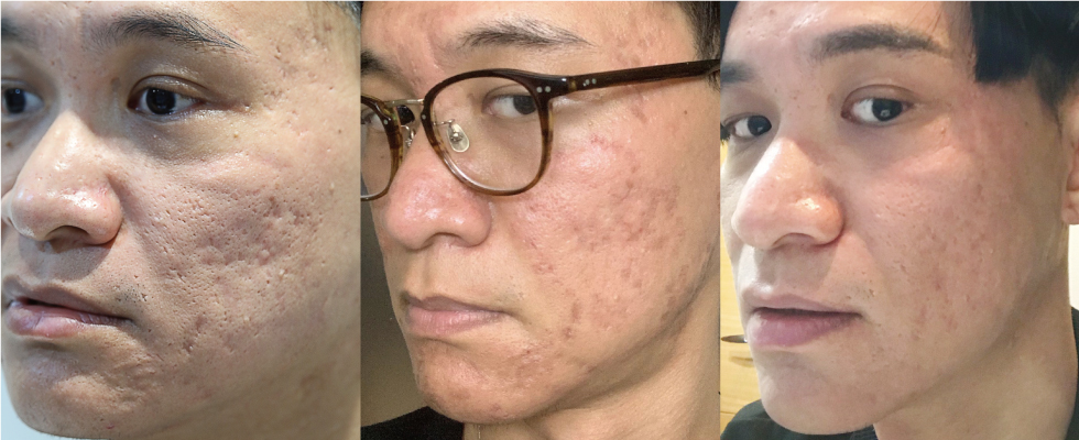 左邊第一張,是我第一次做UP雷射前拍的;中間是UP雷射之後的二天,皮膚表面傷口還有些結痂;最右邊是皮秒雷射+波尿酸填補痘疤較深的部位術後。診所的醫師跟護士還有化妝師都說,我的皮膚進步許多。(照片-個人臉書)