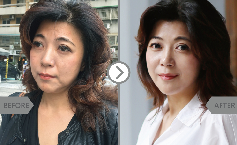 求美不落人後的醫美諮詢師Lily,已經擁有一對出社會的子女(真的看不出來!),還是希望自己看起來是賞心悅目,不希望自己看起來疲憊蒼老!