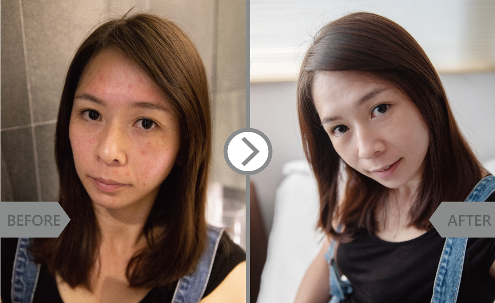 原本還真是小花臉,因為過敏又有斑點,做完MSA酸之後真的是光滑很多。再加上粉刺清乾淨,也比較沒那麼多痘痘了。