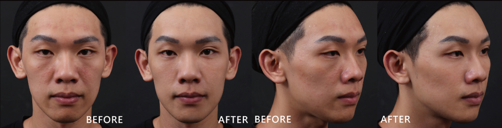 整體膚況啊、皮膚黯沉的狀況都有改善,小瑕疵在透過玻尿酸修飾後,拍照時在臉上完全看不出來,直接Bye!