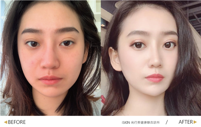 故意拍一張不笑的照片跟療程前比較一下,下巴線條真的變好V唷~